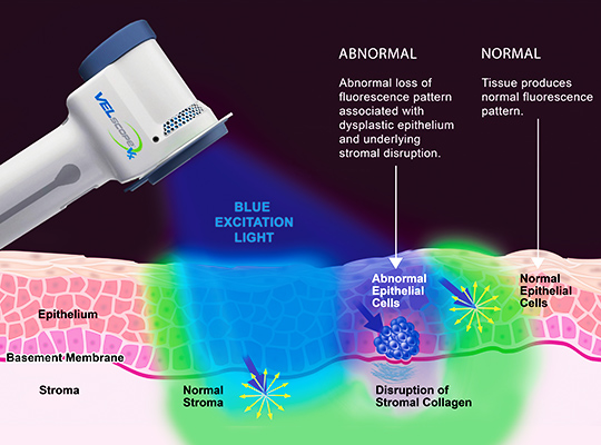Illustration of how VELscope® works for Oral Cancer Screenings.