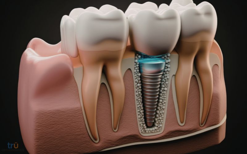 dental implants herndon va