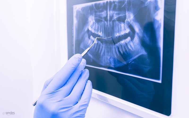 dental x-rays in herndon va