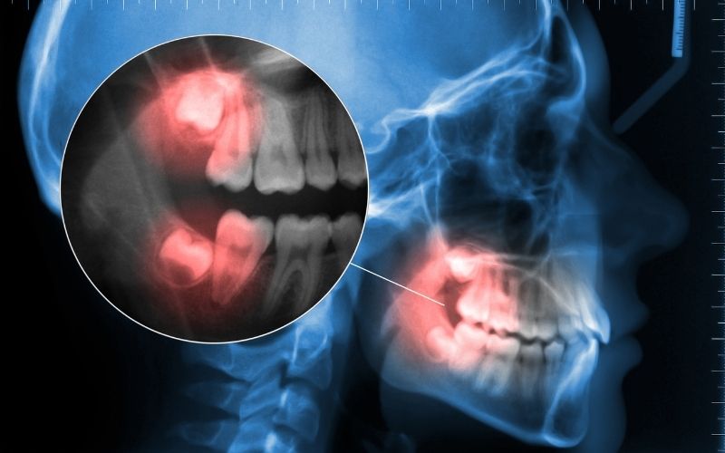 wisdom teeth removal in gainesville va