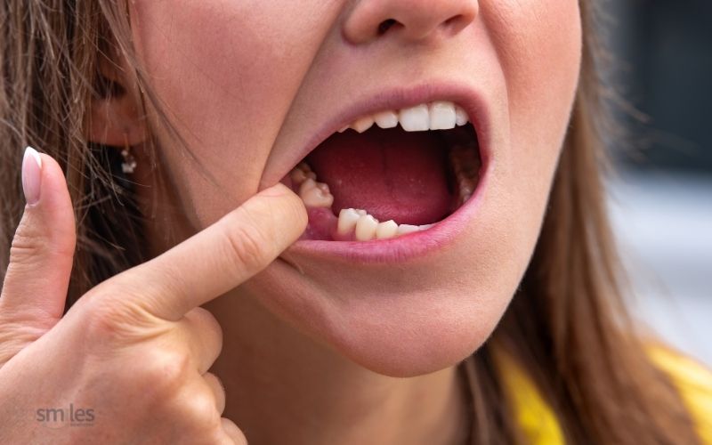 woman with missing tooth, tooth replacement in gainesville, va