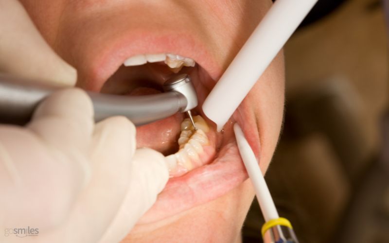 cavity filling herndon va